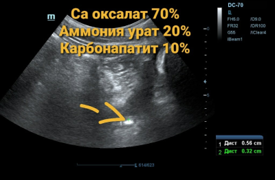 УЗИ мочевого пузыря